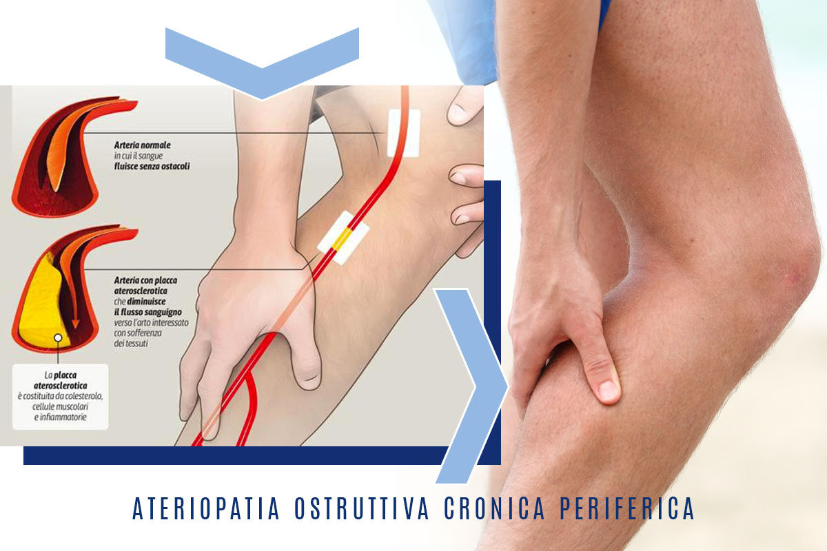 Arteriopatia cronica ostruttiva periferica