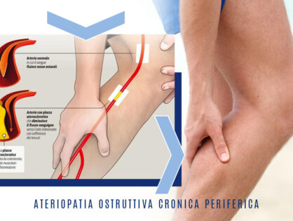 Arteriopatia cronica ostruttiva periferica