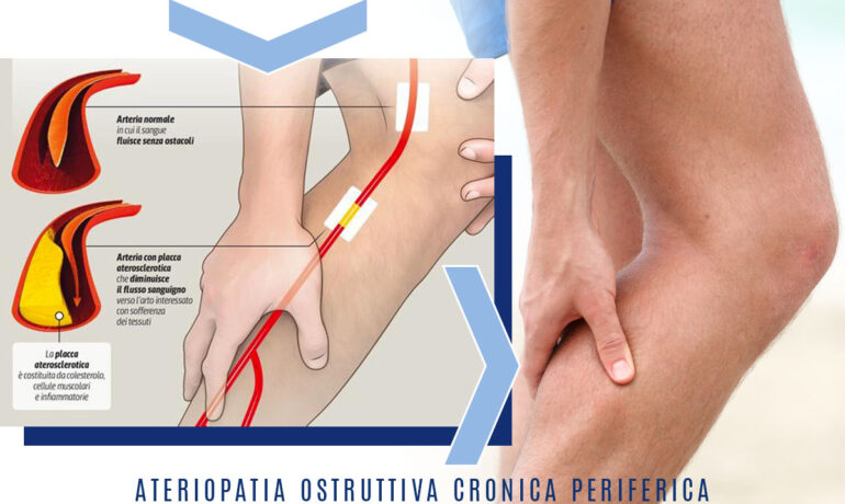 Arteriopatia cronica ostruttiva periferica